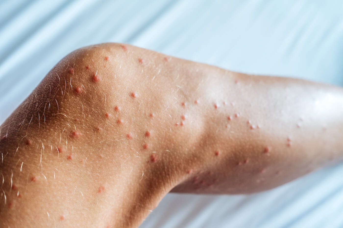 Szeretnél megszabadulni az ágyi poloskától?